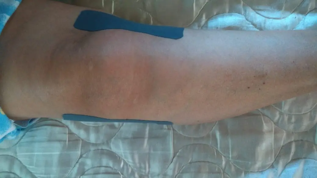 Dolor de rodilla