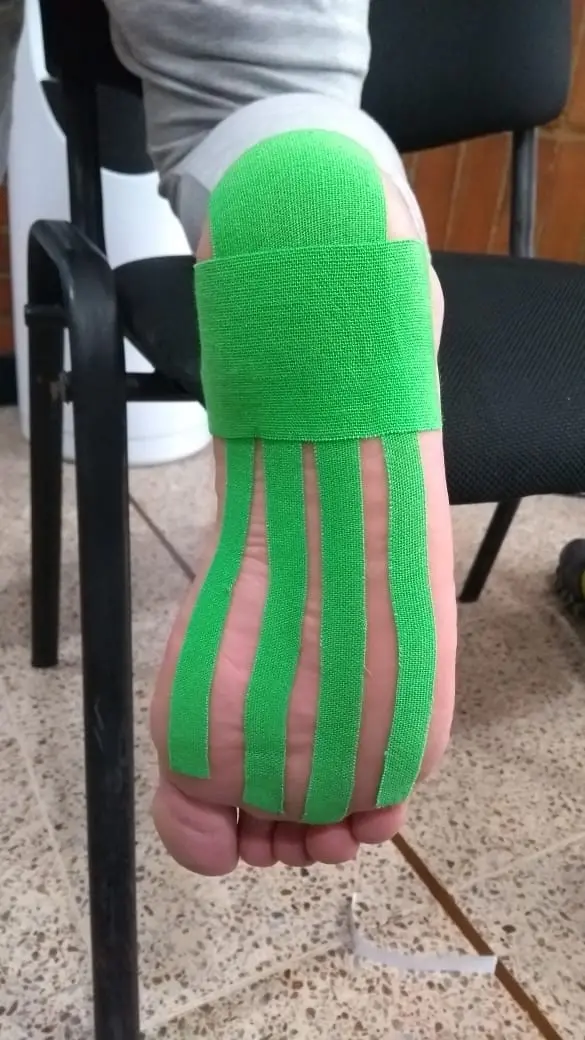 fascitis plantar